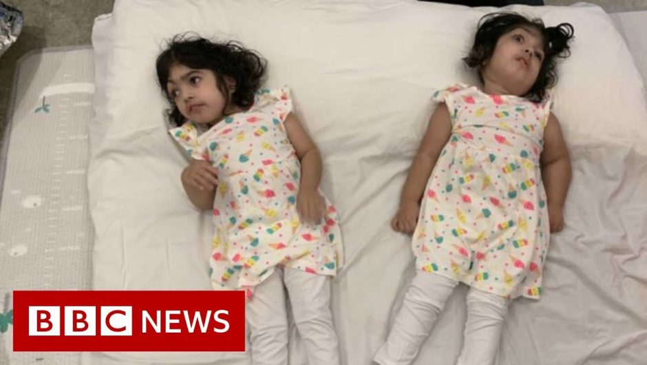 Conjoined twins return home after successful separation – BBC News