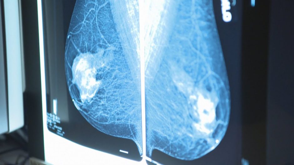 Late cancer diagnoses an impending disaster, experts say