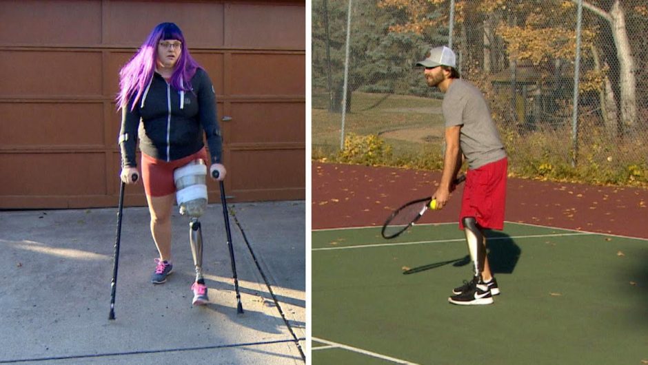 Amputees calling for better prosthetics funding